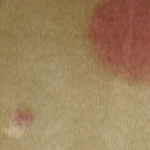 Discoloration Spots